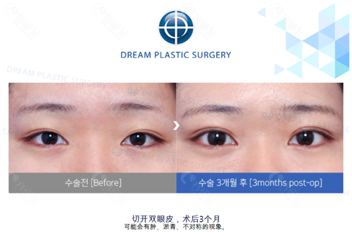 韩国梦想整形外科医院双眼皮手术对比