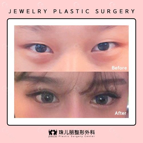 韩国珠儿丽整形外科双眼皮手术对比