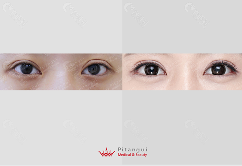 韩国必当归医院双眼皮修复对比图
