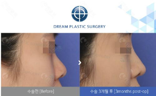 韩国梦想隆鼻手术真人实例