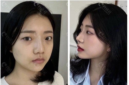 韩国百利酷VG整形外科隆鼻手术对比图