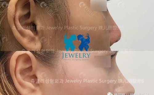 韩国珠儿丽整形外科隆鼻手术对比图
