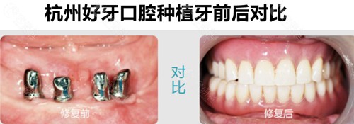 杭州好牙口腔种植牙真人实例