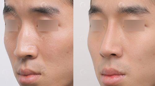 韩国GNG整形外科金惠英博士驼峰鼻矫正前后对比图