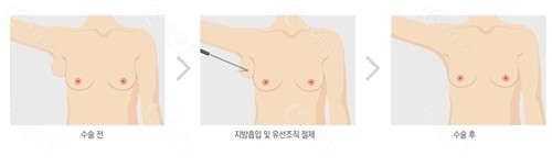 韩国波轮美整形外科副乳整形怎么样