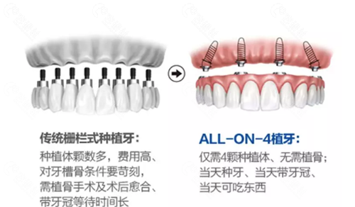 传统种植牙和all-on-4种牙技术区别