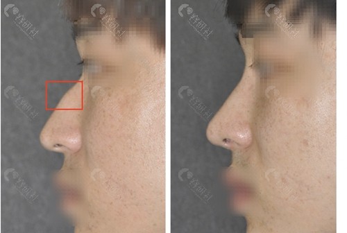 韩国will整形外科医院鼻部整形对比照