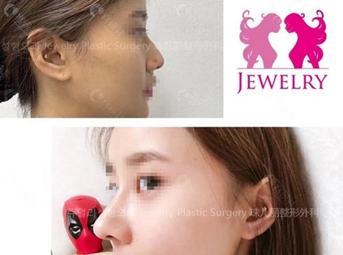韩国珠儿丽整形外科鼻部整形对比照