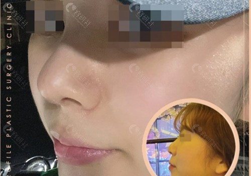 韩国普罗菲耳整形外科医院鼻部整形对比照