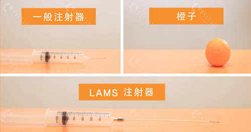 兰斯（LAMS）吸脂注射器和传统注射器区别
