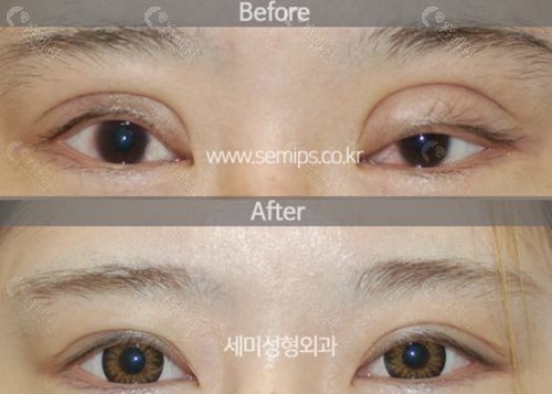 韩国世美SEMI整形外科双眼皮过宽/不对称修复前后对比图