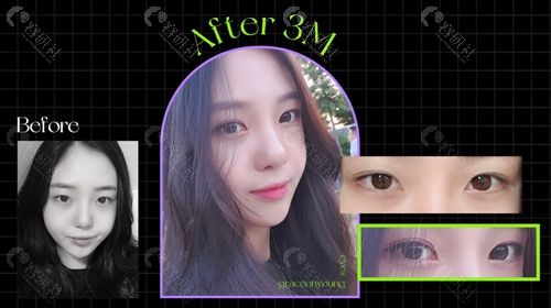 韩国格瑞斯噢爱美整形外科双眼皮术前和术后3个月图片