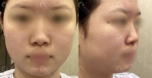 韩国TS整形外科隆鼻手术前照片