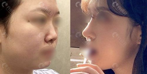韩国TS整形外科隆鼻手术前后对比照