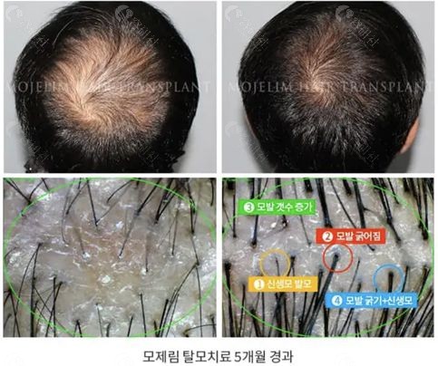 韩国毛杰琳整形外科头顶加密种植对比照