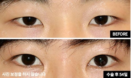韩国EH爱护医院眼眸矫正术前后对比照