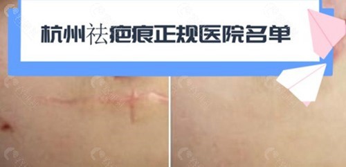 杭州祛疤痕正规医院名单已发布。