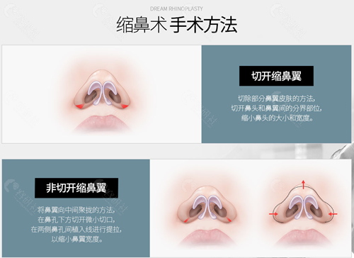 韩国梦想整形外科医院缩鼻翼方法