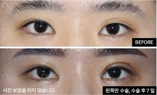韩国EH爱护整形外科多眼皮变双眼皮照片