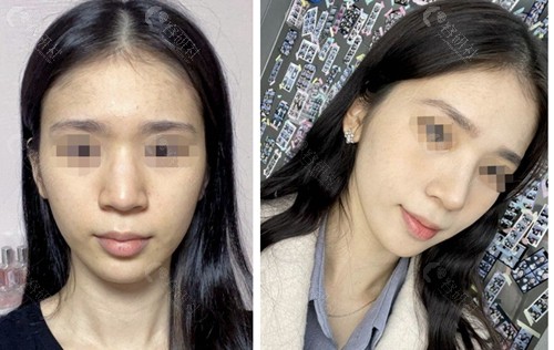 韩国优雅人整形外科医院鼻部整形对比图