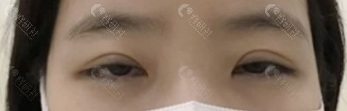 韩国爱护整形外科双眼皮过宽+上睑下垂矫正手术前