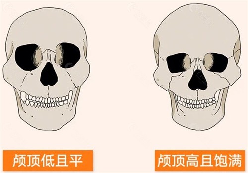 图解高颅顶和低颅顶有啥区别