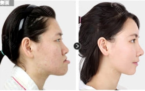 韩国菲斯莱茵faceline整形外科凸嘴矫正对比图