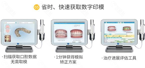 邵阳大众芙蓉口腔医院矫正口扫取模