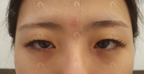 韩国爱护医院做双眼皮修复前的照片