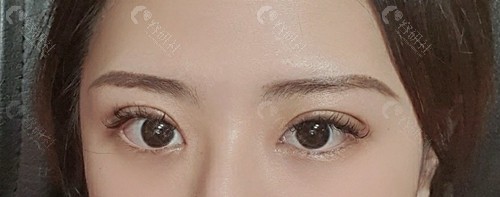 韩国爱护医院做双眼皮修复两周后的样子