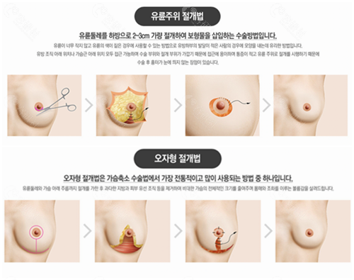 韩国波轮美整形外科缩胸手术方法
