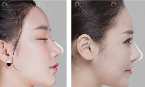 韩国梦想整形外科医院鼻子整形