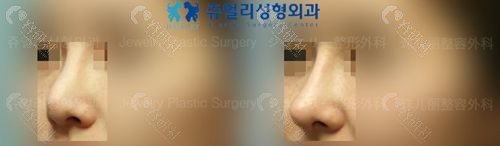 韩国珠儿丽整形外科鼻尖整形对比图