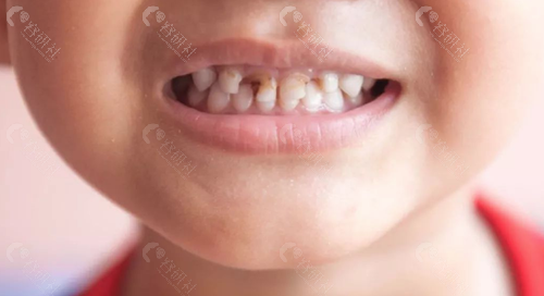 小孩乳牙龋齿