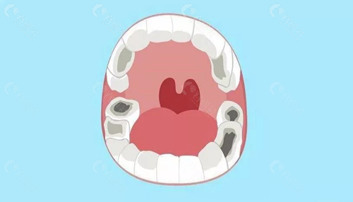 乳牙龋齿治疗有哪几种方式