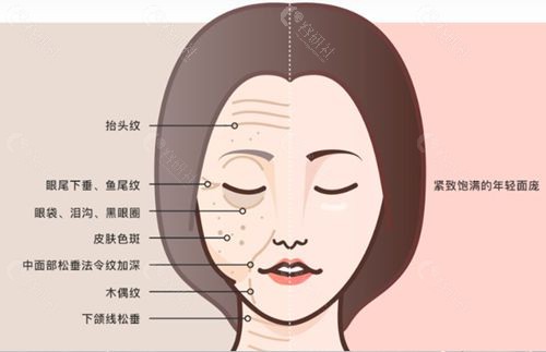拉皮手术能让人回到20岁的状态？