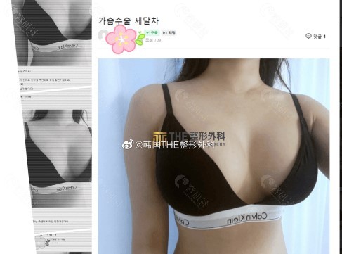 韩国THE整形外科假体隆胸