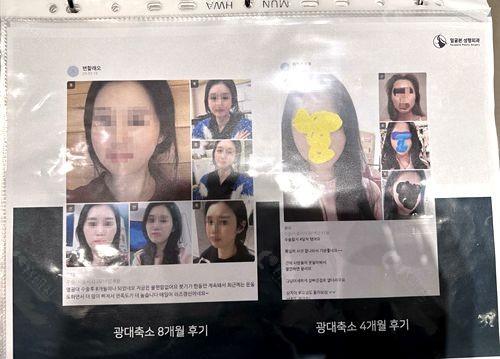 韩国脸本脸骨facebone整形外科医院面部轮廓整形宣传册