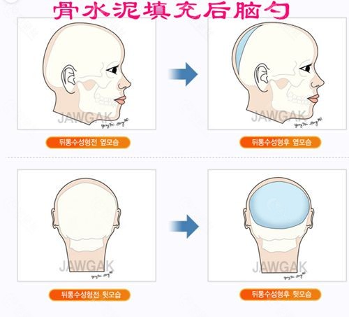 骨水泥填充后脑勺手术有哪些后遗症？