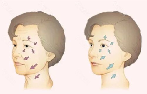 拉皮手术后表情僵硬出现面具脸是不是后遗症引起的？