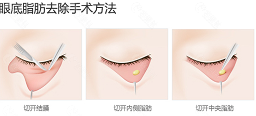 韩国必当归医院眼底脂肪去除方法