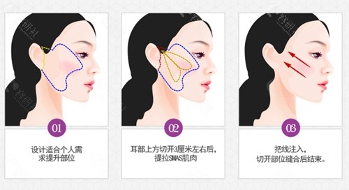 QMC面部提升手术方法