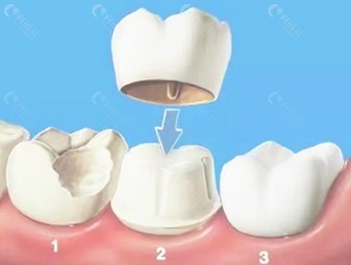 门牙断了植牙能修复吗？