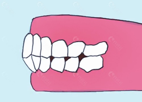 牙齿前凸要怎么矫正呢？