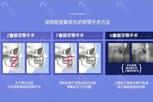 韩国FACELINE整形外科双鄂手术技术优势