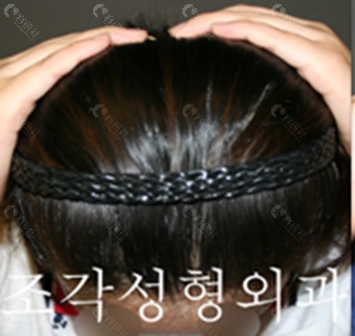 韩国雕刻整形外科扁头变圆头术前