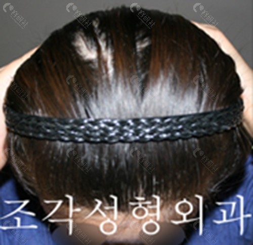 韩国雕刻整形外科扁头变圆头术后样子
