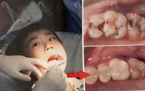孩子乳牙龋齿不加以治疗，会有什么危害？