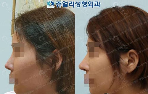 韩国珠儿丽整形外科隆鼻对比