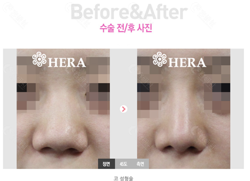 赫拉整形外科鼻修复对比
